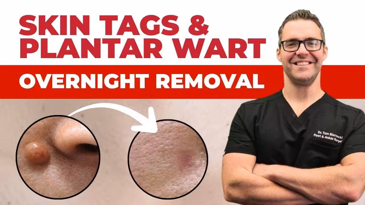 Plantar Wart Treatment & Removal | Balance Foot & Ankle