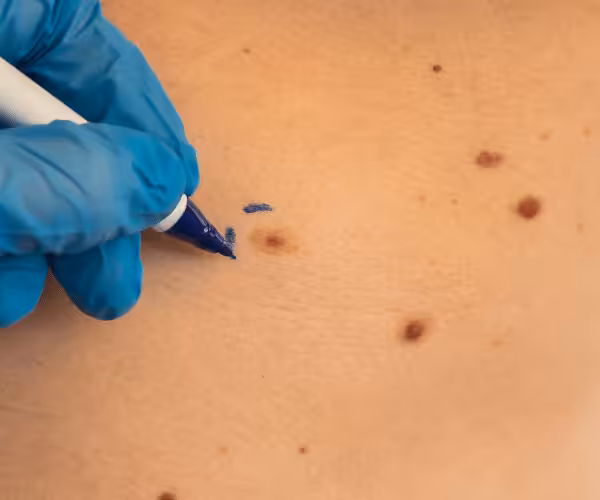 skin tag removal by podiatrist
