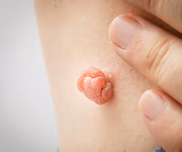 skin tag removal near you
