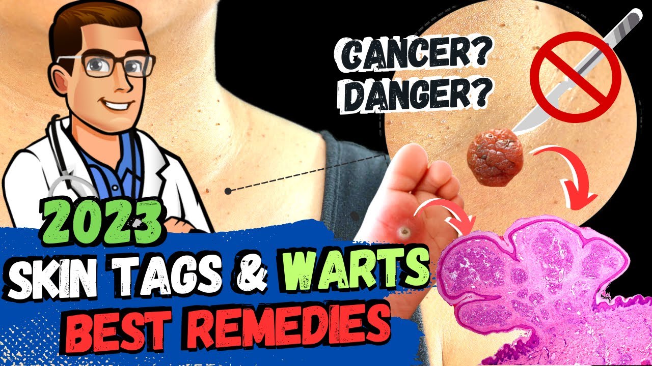 skin tags vs warts vs skin cancer best home remedies 1 secret