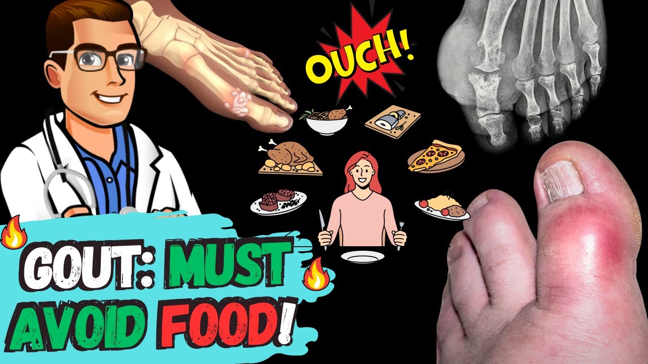 best gout diet foods to avoid uric acid foods that cause gout