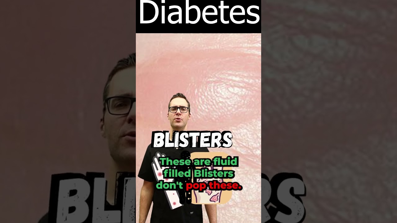 blister on foot toe or between toes diabetic skin symptoms
