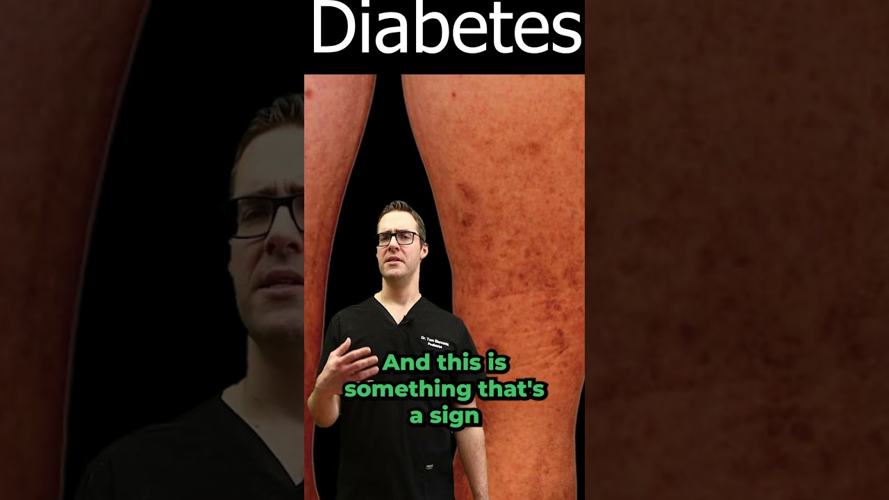 diabetic dermopathy pictures treatment diabetes symptoms signs