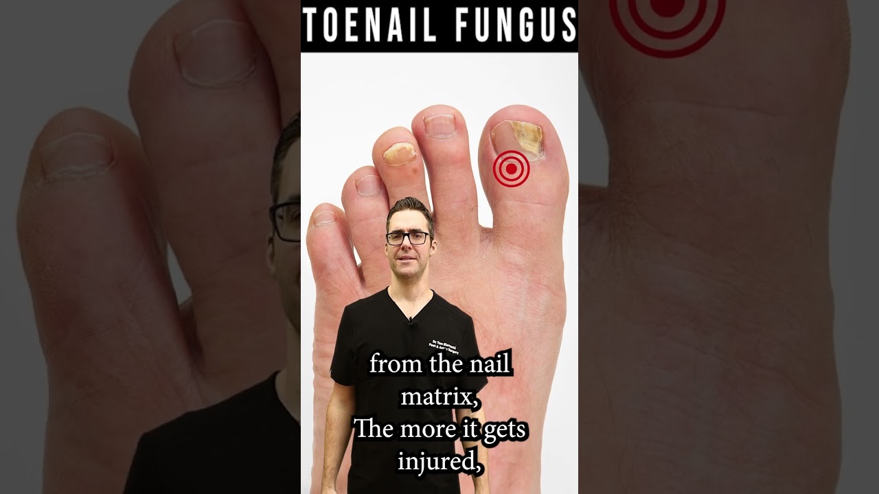 how to know if toenail fungus is dying how fast do nails grow