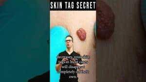 How To Remove Skin Tags Forever! [Skin Tag Removal Secret] | Balance Foot & Ankle