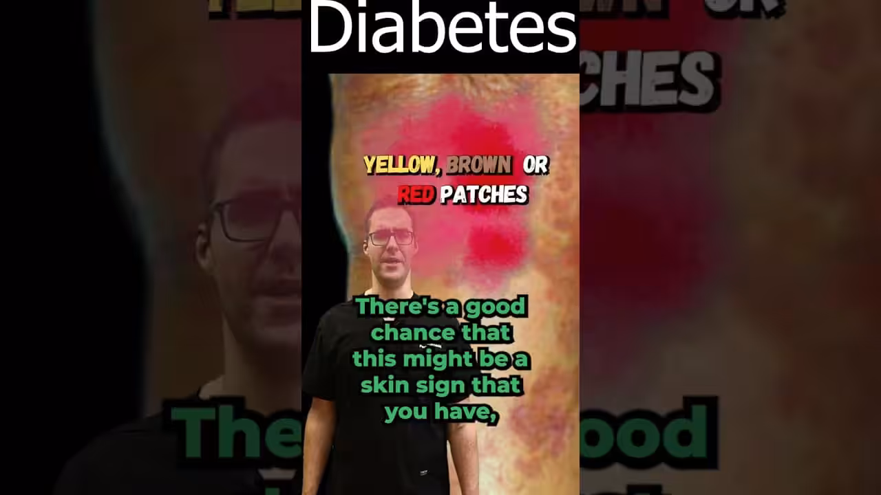 Necrobiosis Lipoidica Diabeticorum [Diabetes Symptoms & Sign] | Balance Foot & Ankle