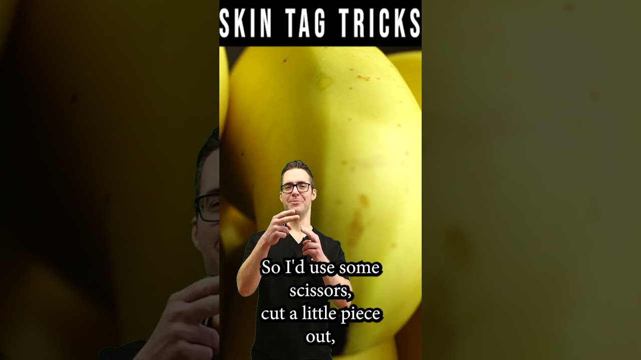 skin tag removal wart removal natural remedy banana peel trick