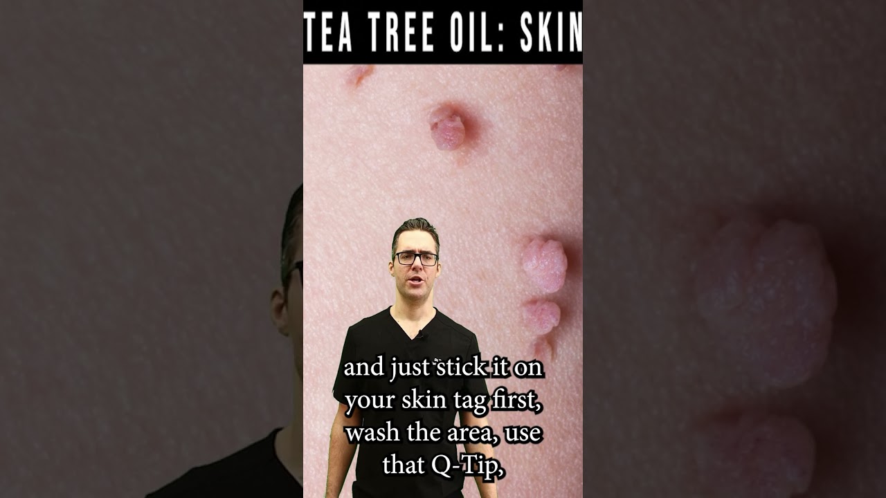 skin tag removal wart removal tea tree oil natural remedy