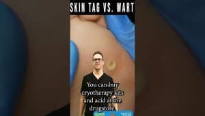 Skin Tags Vs Warts Removal? [How To Get Rid Of Skin Tags & Warts] | Balance Foot & Ankle