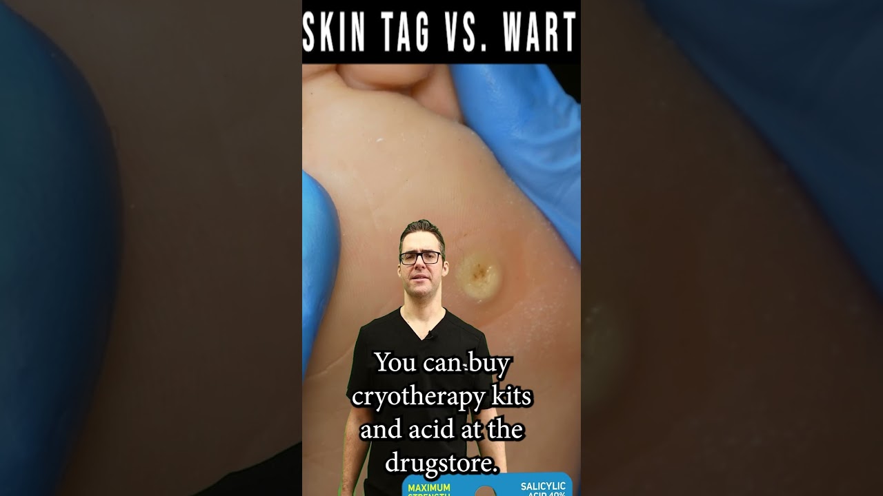 skin tags vs warts removal how to get rid of skin tags warts