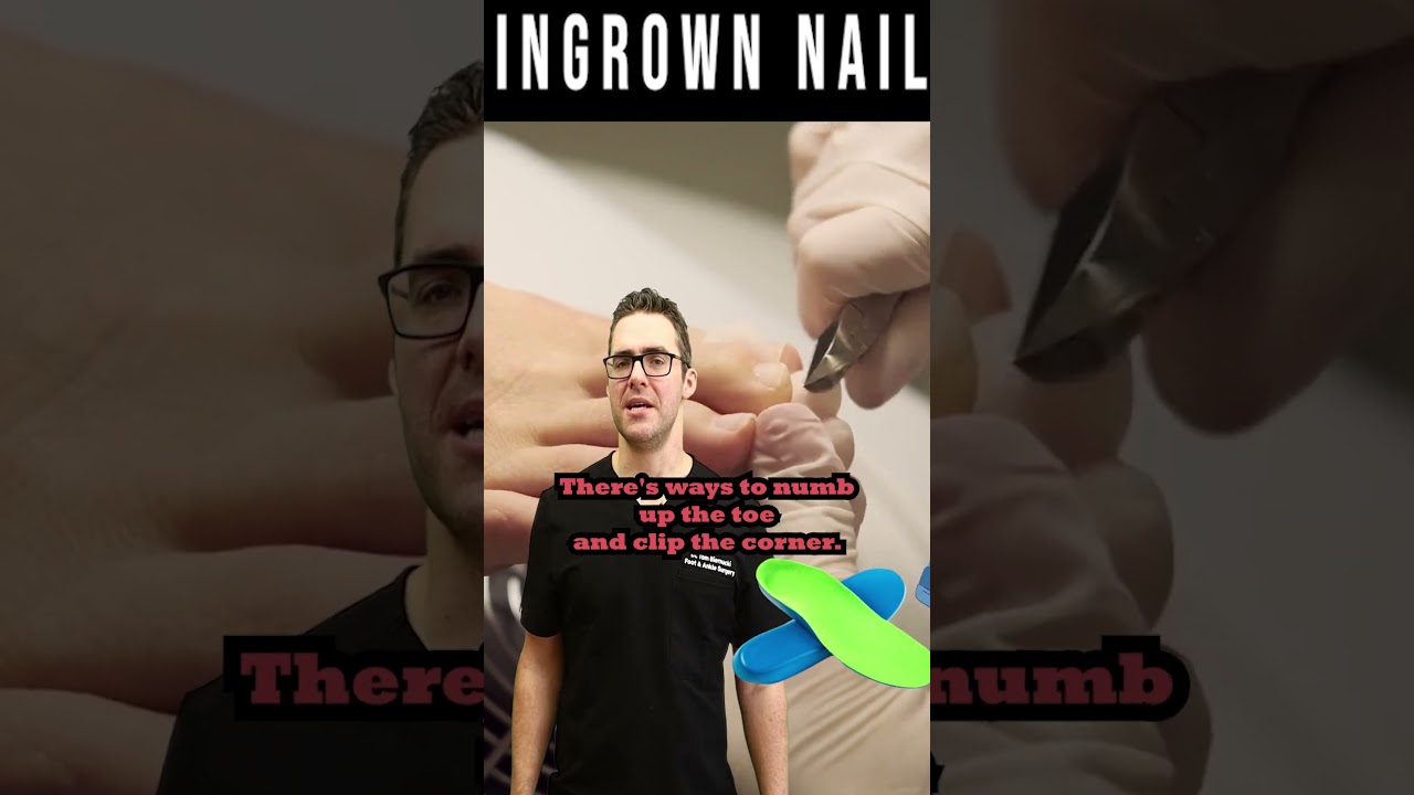 how to get rid of an ingrown toenail ingrown toenail removal