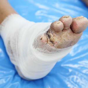 Don't Let A Diabetic Foot Ulcer Turn Into An Amputation 1 foot ulcer