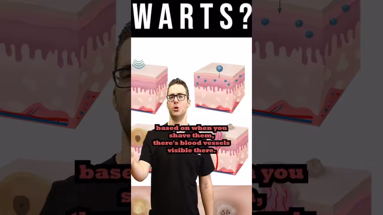 How to Identify a Wart