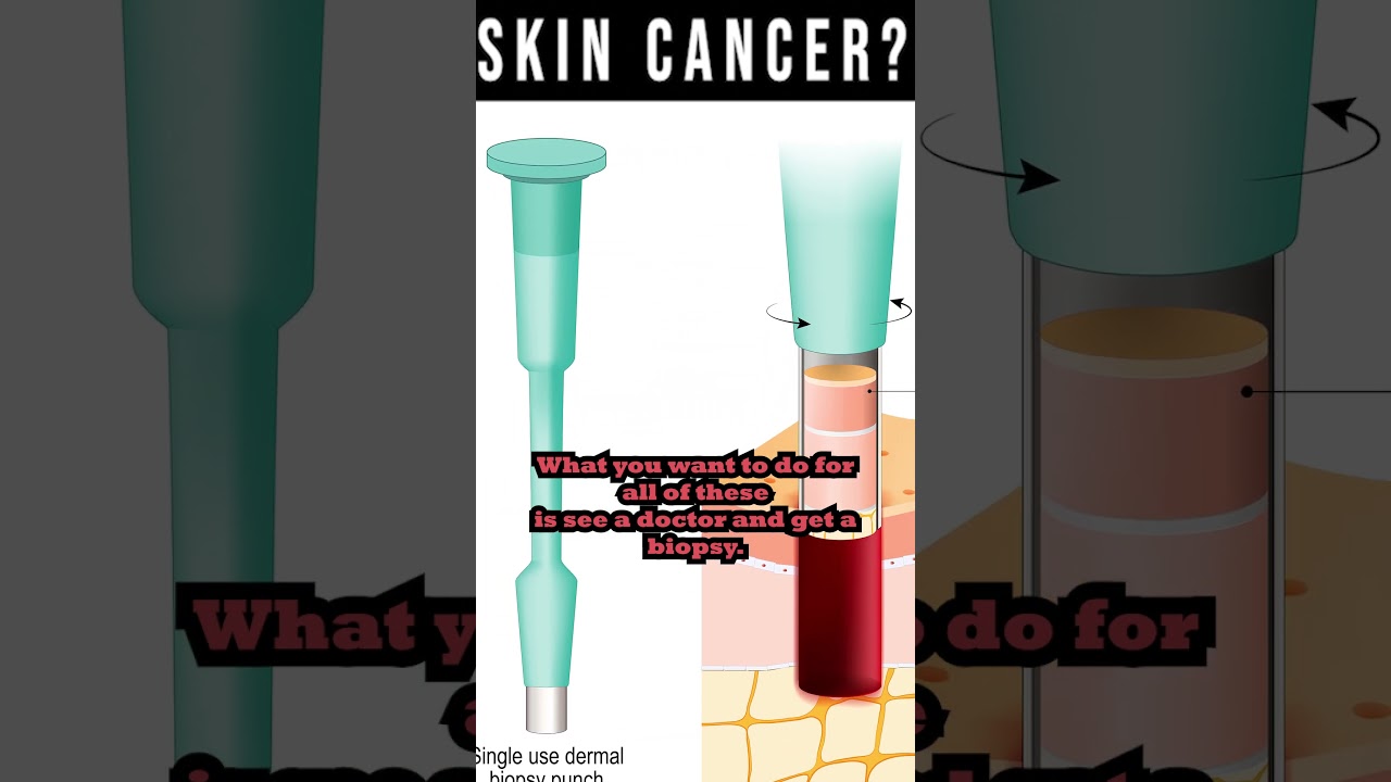 skin cancer don t ignore the warning signs