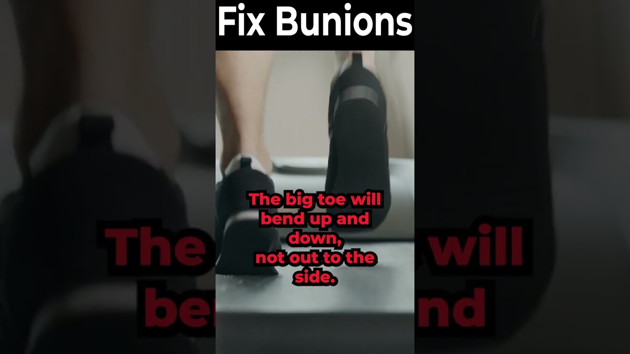 what causes a bunion the real cause what is a bunion for real