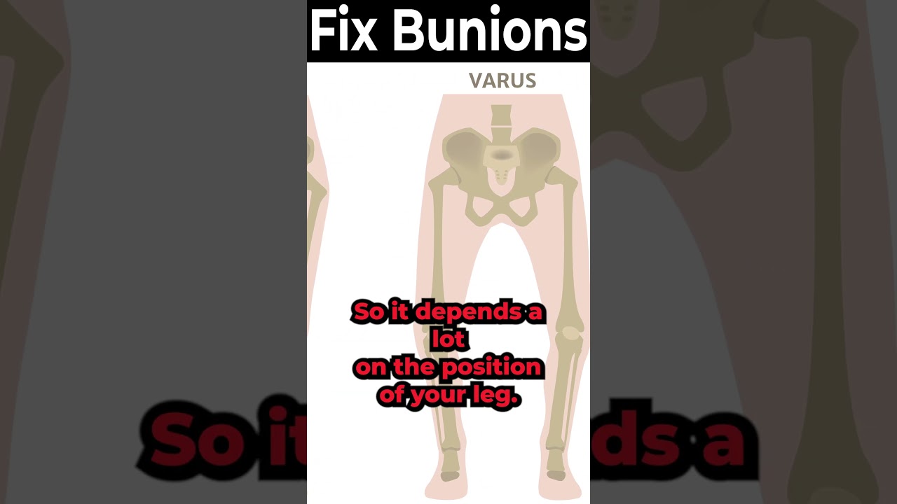 what causes bunions on feet for real what are bunions really