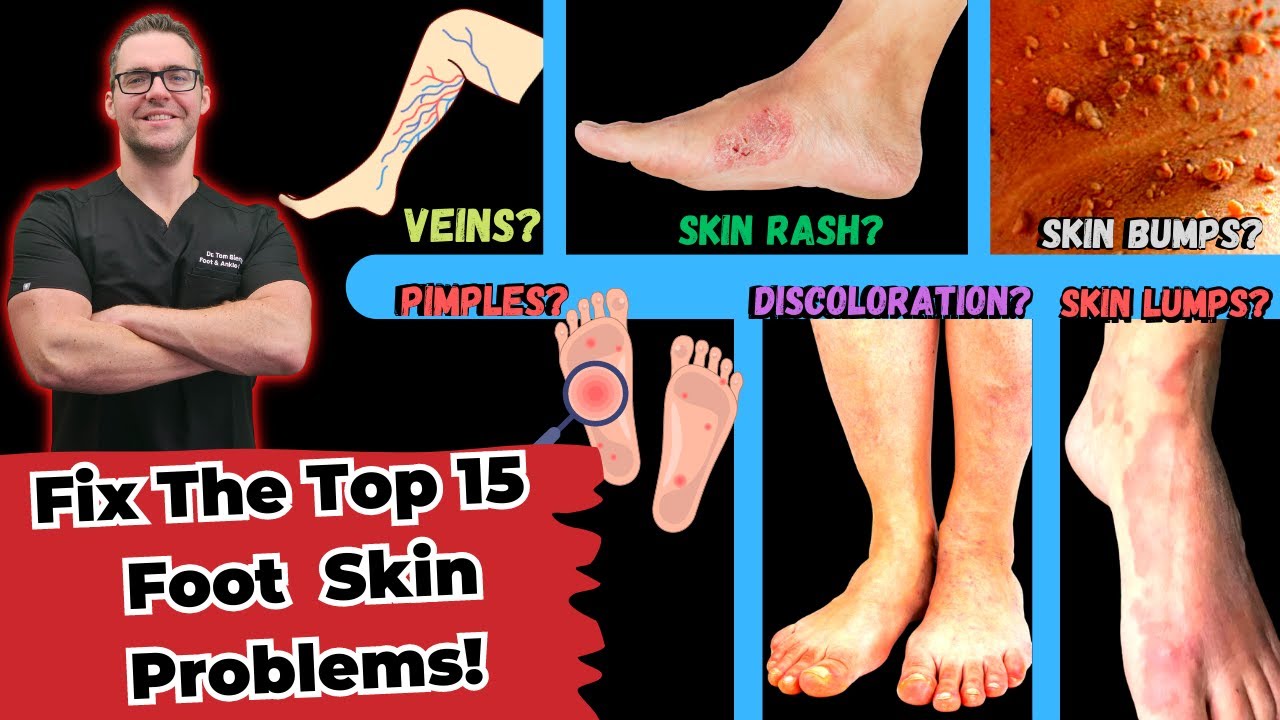 15 most common skin conditions found on the feet how to fix them