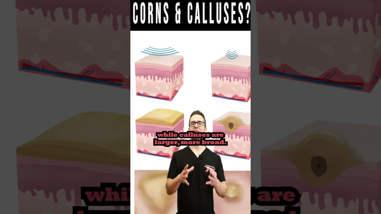 foot corns calluses how to get rid of them for good