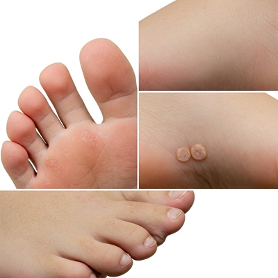 skin conditions on feet