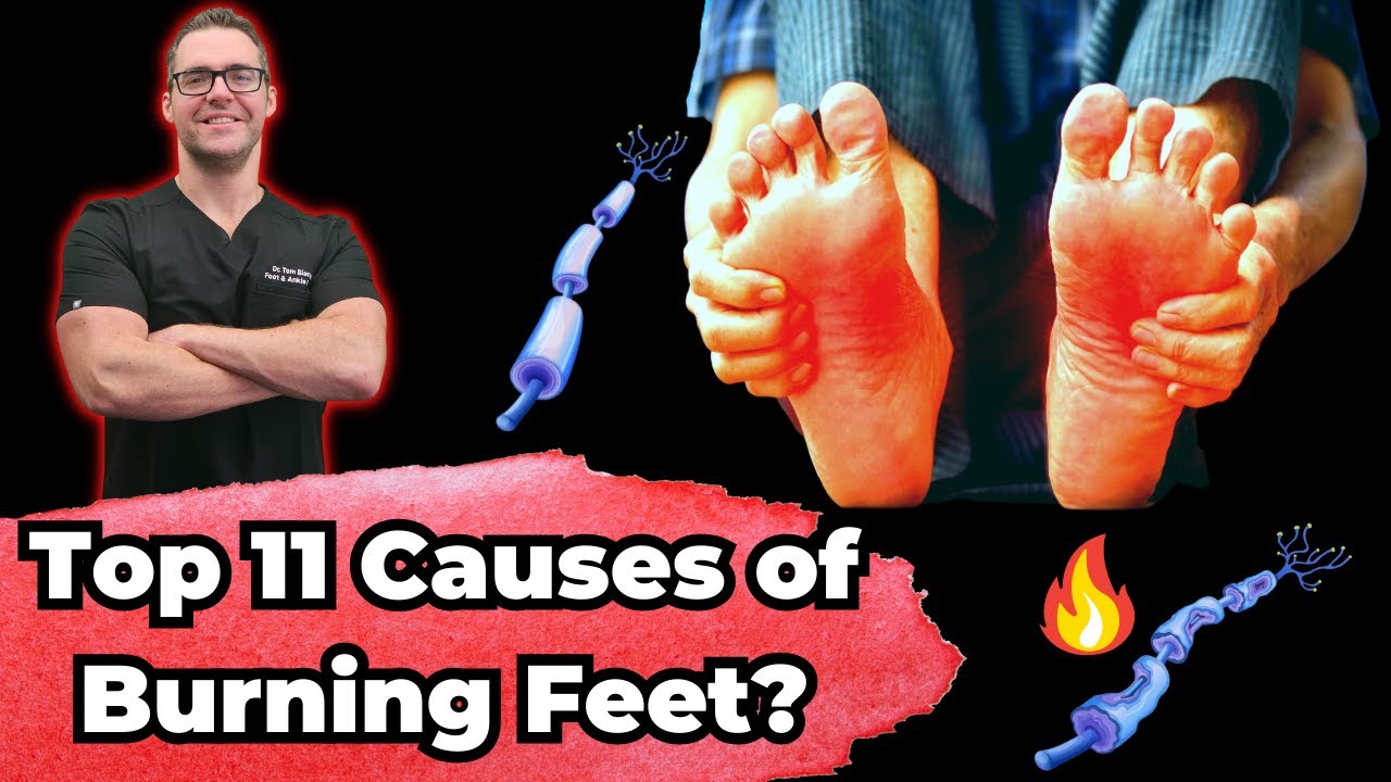 top 11 causes treatments of burning feet