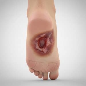 diabetic foot ulcer