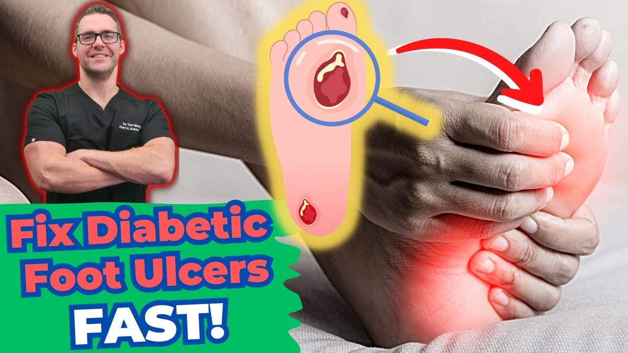 diabetic foot ulcer treatment early stages diabetic neuropathy