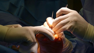 flat foot reconstruction surgery