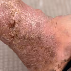 diabetic foot ulcer