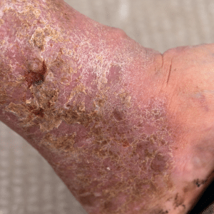 A Diabetic's Worst Nightmare: Foot Ulcers 1 diabetic foot ulcer