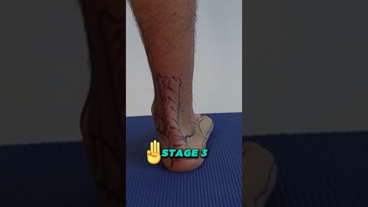stage 4 inside of the ankle pain posterior tibial tendonitis