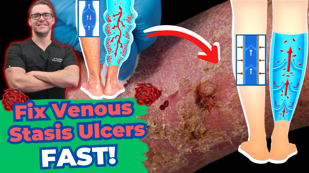 venous stasis dermatitis venous ulcers treatment varicose veins