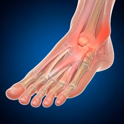 Painful Bunion