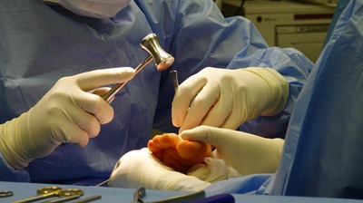 how long does it take to heal from bunion surgery