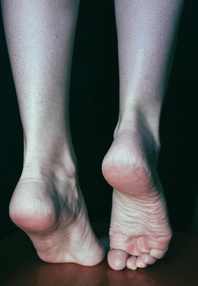 plantar fasciitis vs heel spur