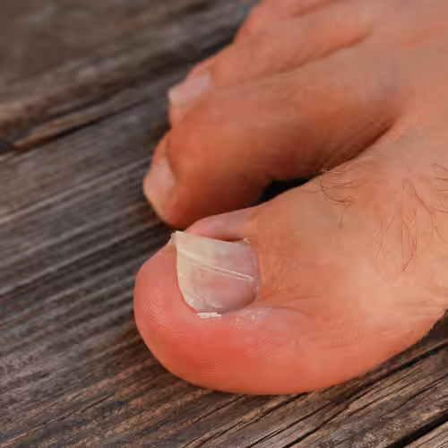 Toenail Matrixectomy