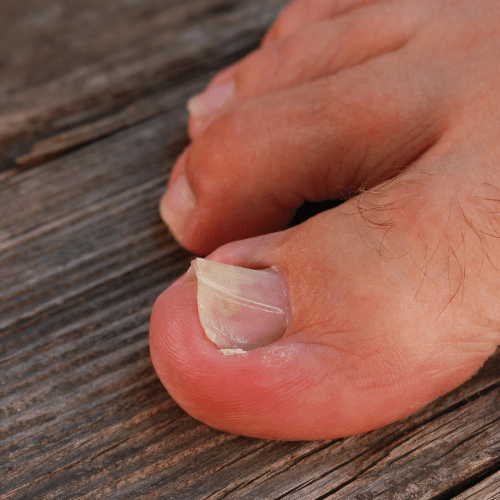 Toenail Matrixectomy Howell 1 Toenail Matrixectomy