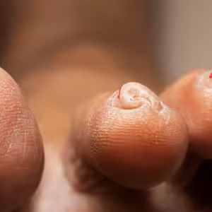 foot fungus treatment