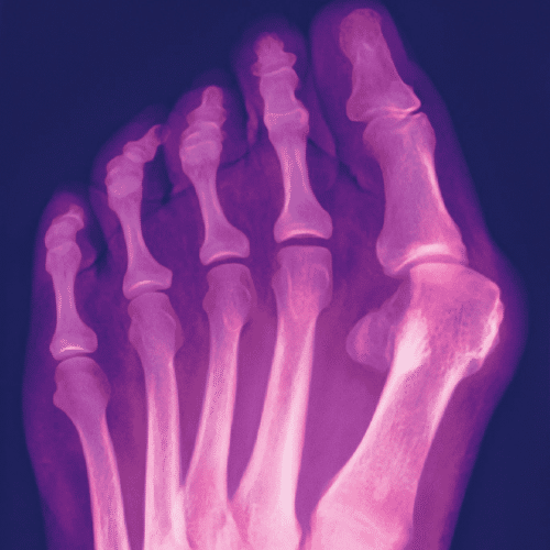 Bunion Surgery 1 bunion surgery near me