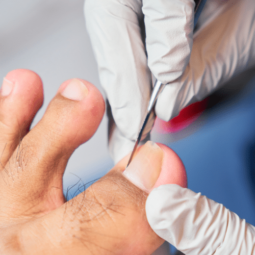 ingrown toenail removal