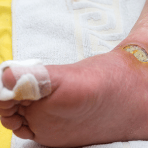 Diabetes Foot Ulcer Treatment
