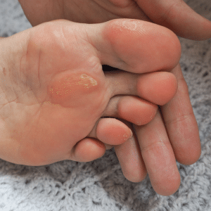 foot corn cure
