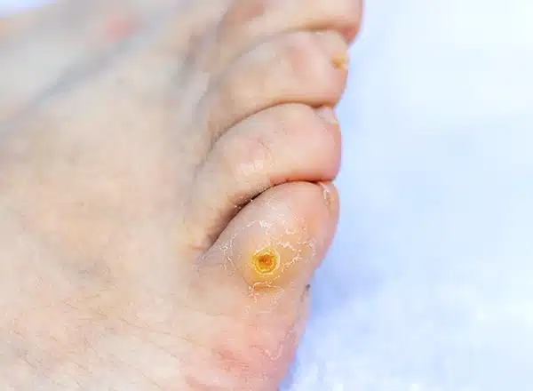 Corn Callus Removal​