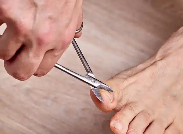 Safe Toenail Trimming Debridement​