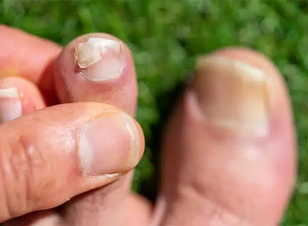 Thick or fungal toenails