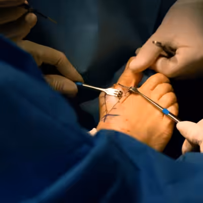 bunion surgery