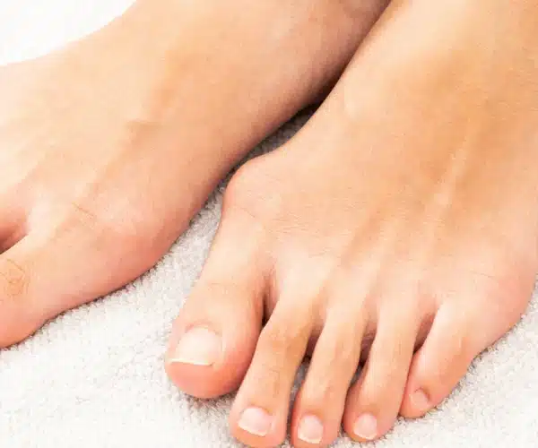 Bunions 2 - Balance Foot & Ankle