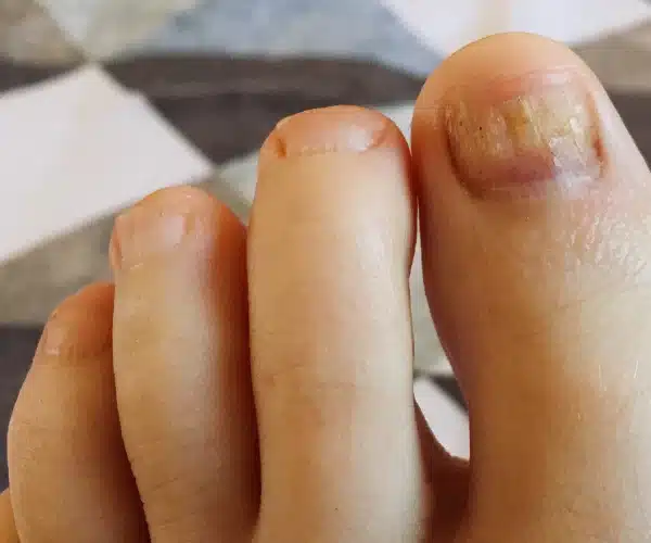 Foot Nail Fungus Treatment 1 - Balance Foot & Ankle