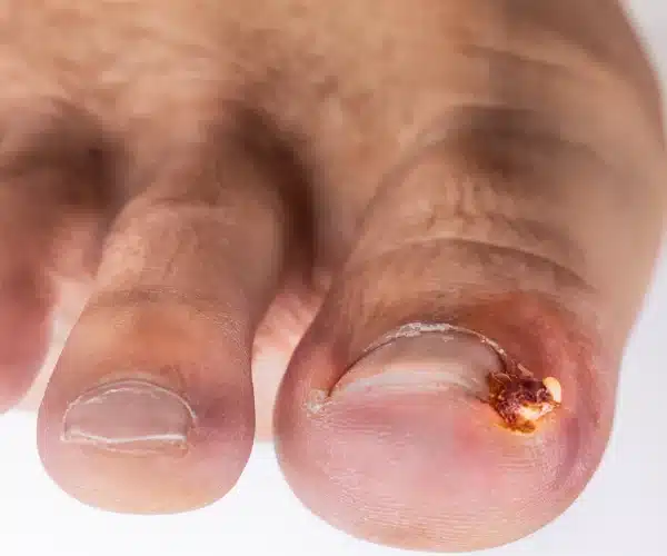 Ingrown Toenails 3 - Balance Foot & Ankle