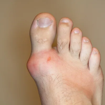 bunion treatment 1