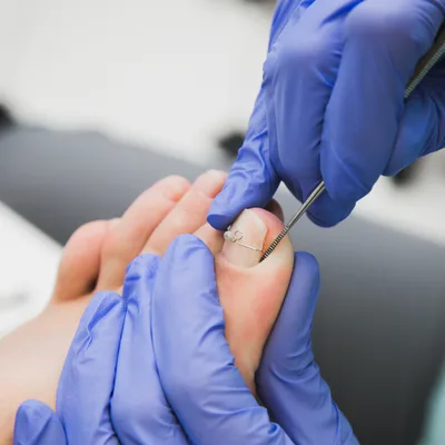 ingrown toenail bloomfield hills